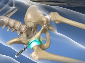 SI Joint Injections/Ablations