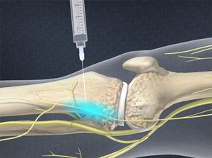 Shoulder Joint Injection