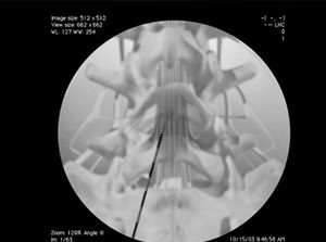 Lumbar Epidural Steroid Injections