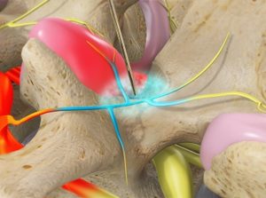 Medial Branch Blocks/Facet Joints