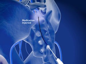 RACZ Catheter Adhesiolysis