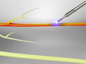 Radiofrequency Ablations