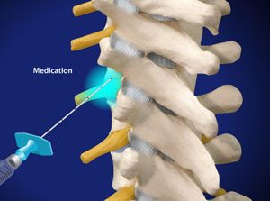 Thoracic Transforaminal Epidural Steroid Injection