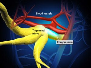 trigeminalneur_300
